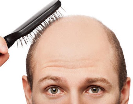 5 Hair-Loss Supplements For Balding Men